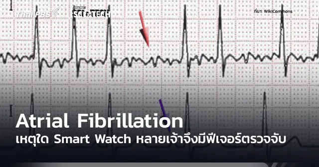 Atrial Fibrillation ภาวะหัวใจห้องบนสั่นพลิ้ว เหตุใดสมาร์ตวอตช์จำนวนมากจึงมีฟีเจอร์ตรวจจับภาวะนี้
