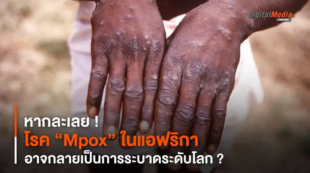 หากละเลย “Mpox” ในแอฟริกา อาจกลายเป็นการระบาดระดับโลก ?