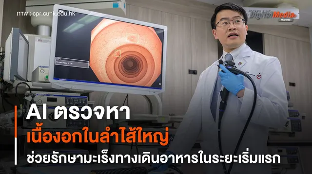 AI ตรวจหาเนื้องอกในลำไส้ใหญ่ ช่วยรักษามะเร็งทางเดินอาหารในระยะเริ่มแรก