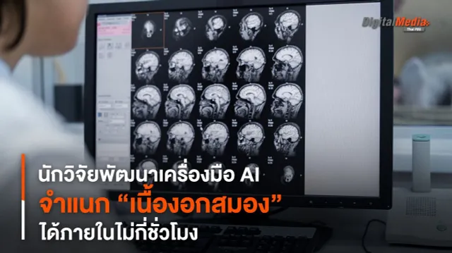 นักวิจัยพัฒนาเครื่องมือ AI จำแนก “เนื้องอกสมอง” ได้ภายในไม่กี่ชั่วโมง