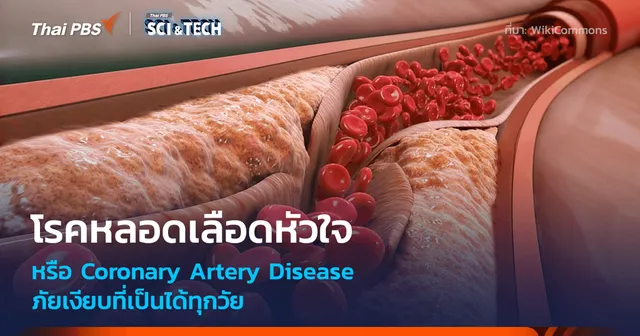 “โรคหลอดเลือดหัวใจ” (Coronary Artery Disease) ภัยเงียบที่เป็นได้ทุกวัย