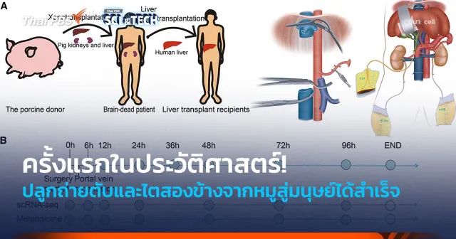ครั้งแรกในประวัติศาสตร์! ปลูกถ่ายตับและไตสองข้างจากหมูสู่มนุษย์ได้สำเร็จ