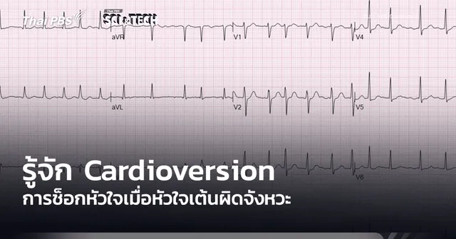 รู้จัก Cardioversion การช็อกหัวใจเมื่อหัวใจเต้นผิดจังหวะ