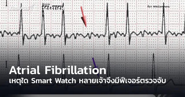 Atrial Fibrillation ภาวะหัวใจห้องบนสั่นพลิ้ว เหตุใดสมาร์ตวอตช์จำนวนมากจึงมีฟีเจอร์ตรวจจับภาวะนี้