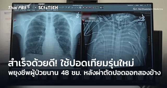 สำเร็จด้วยดี! หมอใช้ปอดเทียมรุ่นใหม่ พยุงชีพผู้ป่วยนาน 48 ชม. หลังผ่าตัดปอดออกสองข้าง