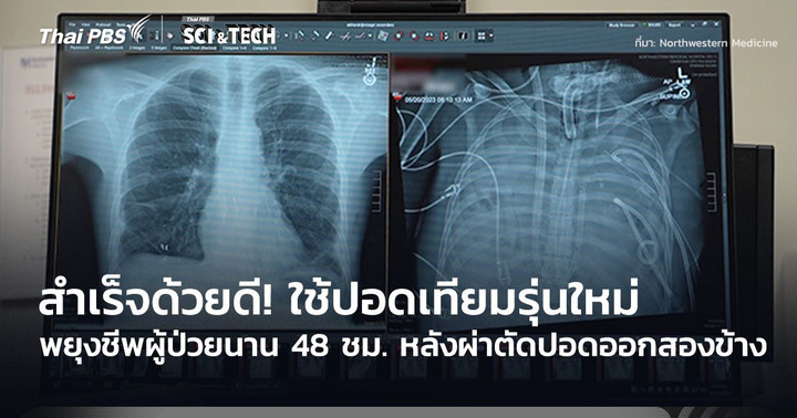 สำเร็จด้วยดี! หมอใช้ปอดเทียมรุ่นใหม่ พยุงชีพผู้ป่วยนาน 48 ชม. หลังผ่าตัดปอดออกสองข้าง
