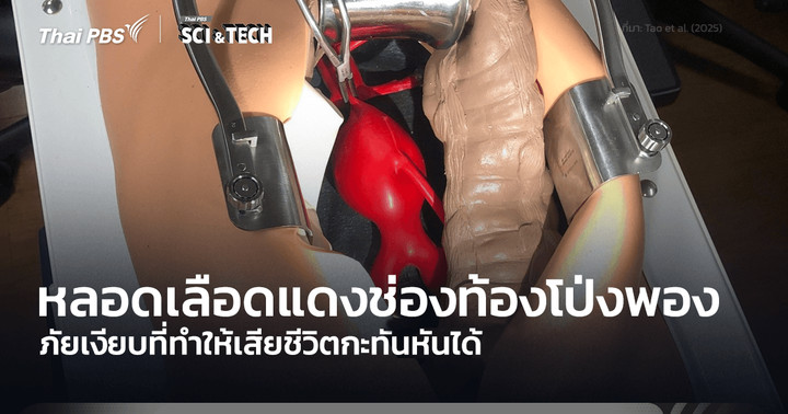 ภาวะหลอดเลือดแดงช่องท้องโป่งพอง ภัยเงียบทำให้เสียชีวิตกะทันหันได้