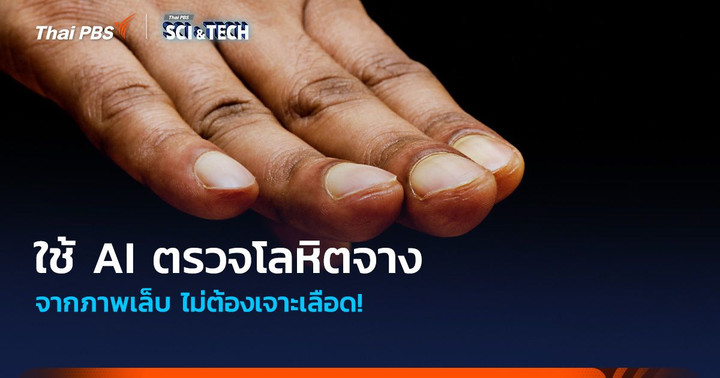 ไม่ต้องเจาะเลือด! พัฒนาแอปฯ ใช้ AI ตรวจโลหิตจางจากภาพเล็บ