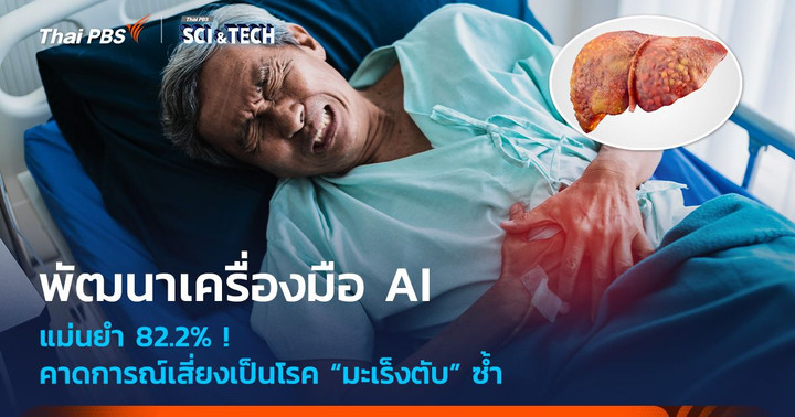 แม่นยำ 82.2% ! พัฒนาเครื่องมือ AI คาดเสี่ยงเป็นโรค “มะเร็งตับ” ซ้ำ