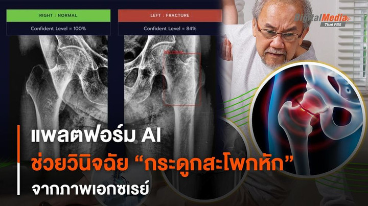 นวัตกรรม AICEDA BoneX ใช้ AI ช่วยวินิจฉัยกระดูกสะโพกหักจากภาพเอกซเรย์