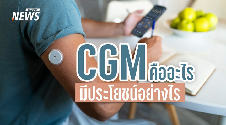 CGM คืออะไร? รู้จักเครื่องวัดระดับน้ำตาลต่อเนื่อง ใครควรใช้ และมีประโยชน์อย่างไร