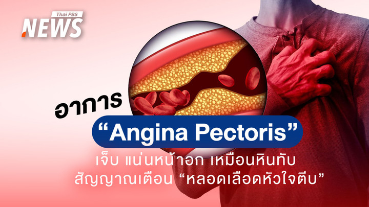 ถอดรหัสภาวะ "Angina Pectoris" สัญญาณเตือนภัยขั้นวิกฤต "หัวใจขาดเลือด"
