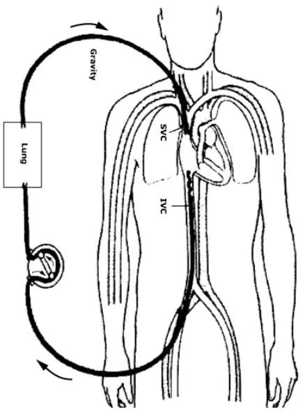 Veno-venous_(VV)