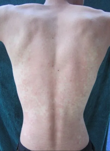 ผื่นคล้ายผื่นแพ้ในผู้ที่มีอาการ Asian Flush Syndrome