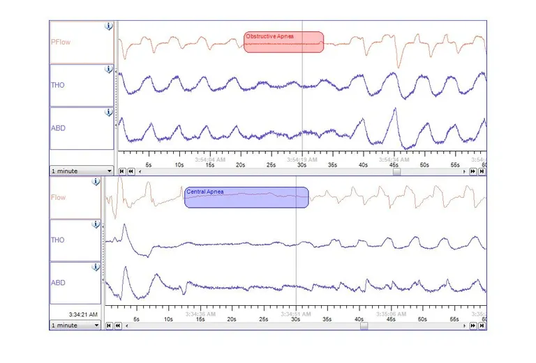 ภาวะหยุดหายใจมีหลัก ๆ อยู่ 2 ชนิด คือ Obstructive Sleep Apnea และ Central Sleep Apnea