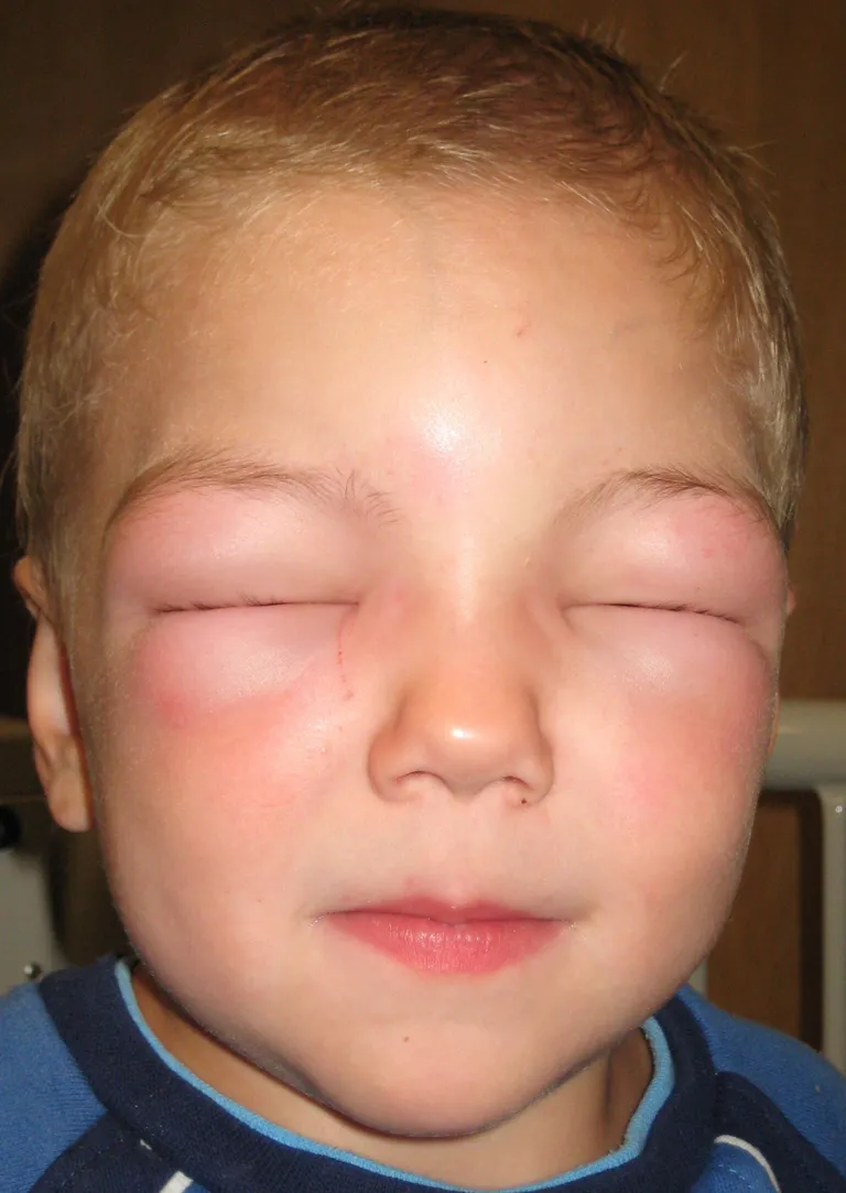 การบวมของเนื้อเยื่อใต้ผิวหนังหรือ Angioedema ในอาการแพ้รุนแรง