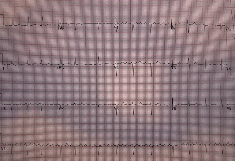 การเต้นของหัวใจแบบผิดจังหวะที่เรียกว่า _Atrial Flutter_ ซึ่งเกิดขึ้นเมื่อหัวใจห้องบนสั่นระริก ทำให้ไม่สามารถสูบฉีดเลือดได้อย่างมีประสิทธิภาพ