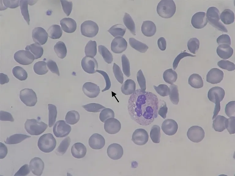 Blood Smear ของผู้ป่วย SCD แสดงให้เห็นเม็ดเลือดแดงรูปเคียว