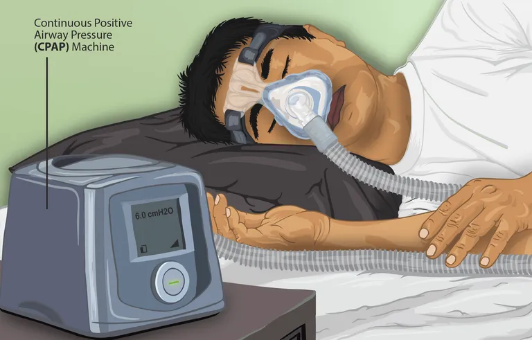 เครื่องช่วยหายใจแบบ CPAP ซึ่งใช้ในการป้องกันการหยุดหายใจขณะหลับ