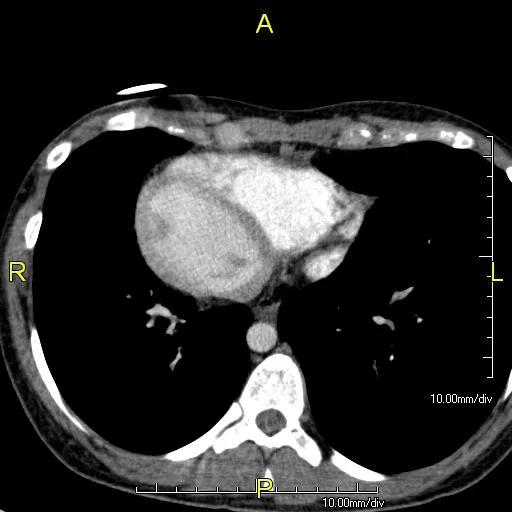 ภาพ CT Scan ของภาวะ Dextrocardia