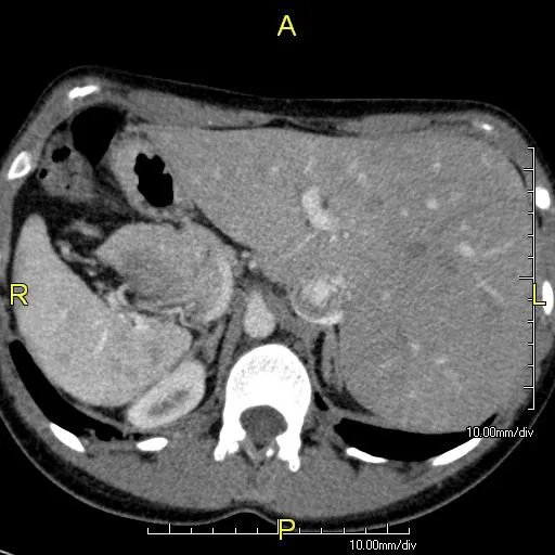 ภาพ CT Scan ทรวงอกของภาวะ Situs inversus แสดงให้เห็นม้ามที่อยู่ด้านขวาและตับที่อยู่ด้านซ้าย