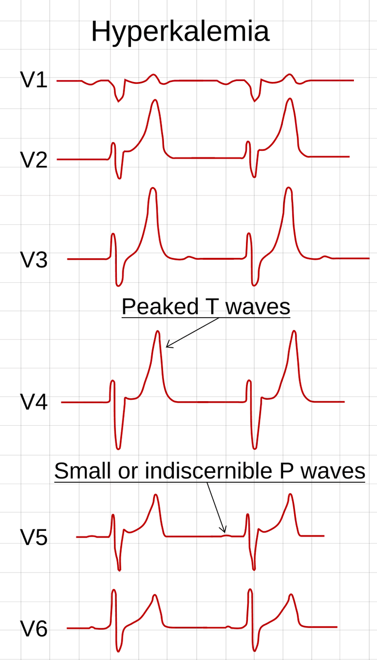 ECG ในผู้ที่มีภาวะโพแทสเซียมสูง Hyperkalemia