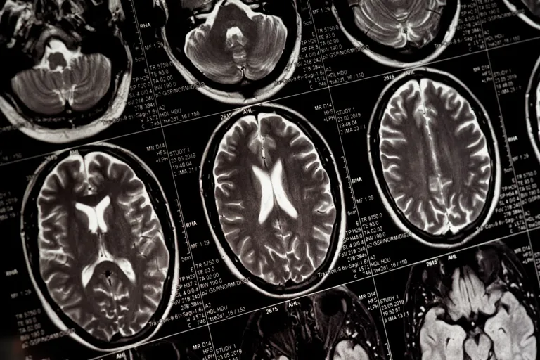 Magnetic Resonance Imaging หรือ MRI คือ เครื่องมือในการตรวจหาความผิดปกติของร่างกาย โดยใช้เครื่องสนามแม่เหล็ก และคลื่นความถี่วิทยุ สร้างภาพที่มีความละเอียดสูง