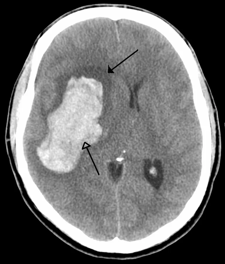 ภาพ MRI แสดงภาวะเลือดออกในสมองหลังจากเส้นเลือดในสมองแตก