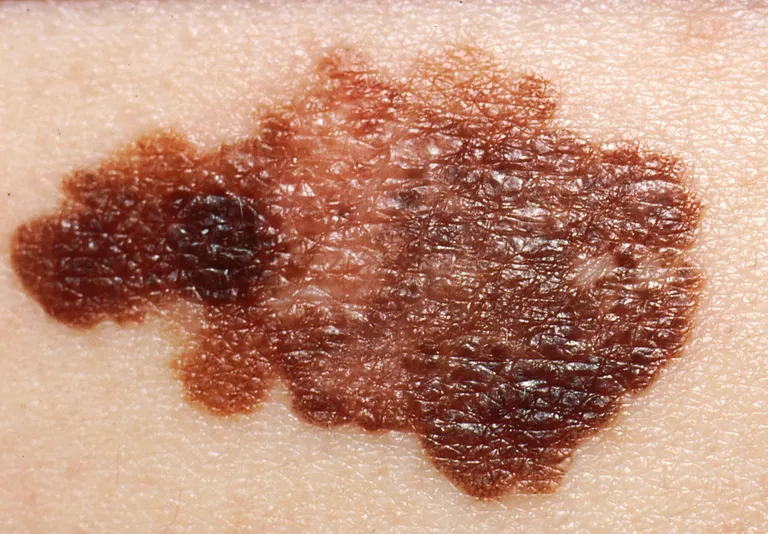 ภาพถ่ายผิวหนังที่มีรอยโรคมะเร็งผิวหนังชนิด Melanoma
