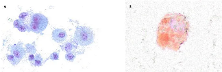 Microscopy_of_a_bronchoalveolar_lavage_sample