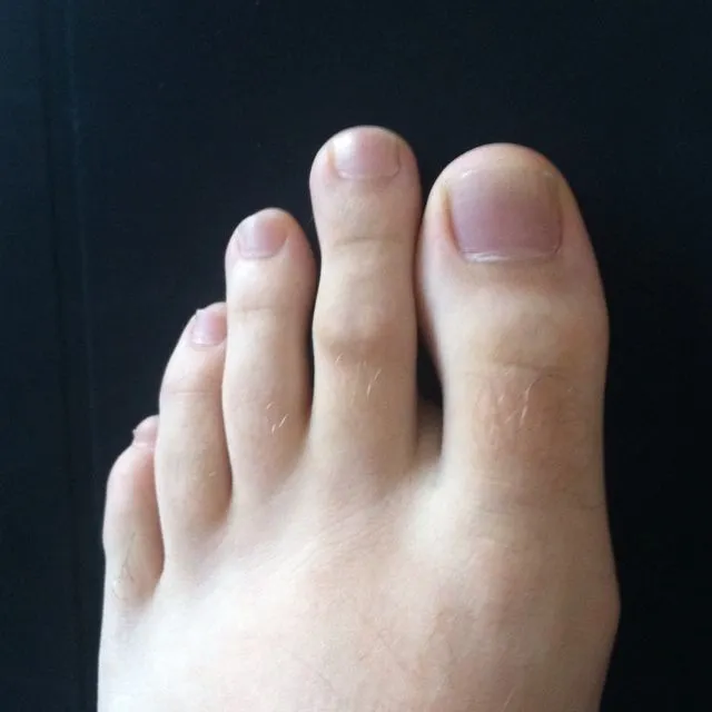Morton's toe แบบไม่รุนแรง เห็นได้ว่านิ้วโป้งเท้านั้นสั้นกว่านิ้วชี้เท้าอย่างเห็นได้ชัด