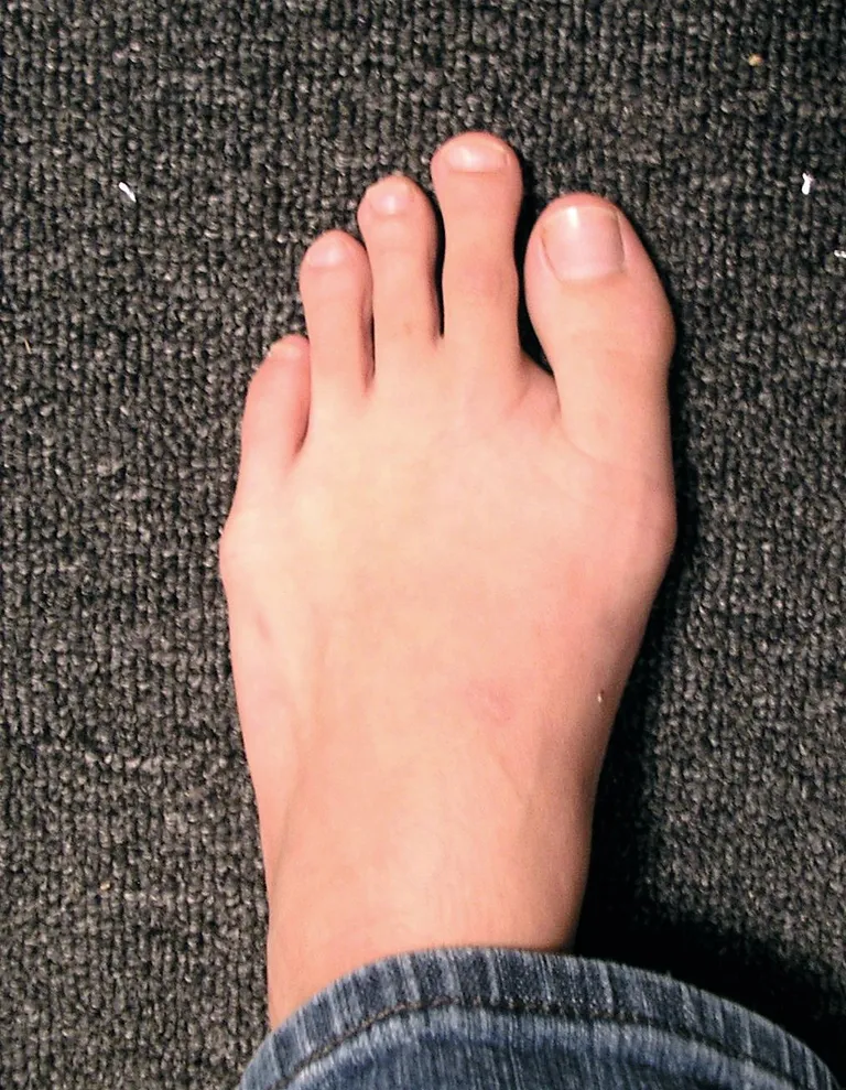 Morton's toe ชนิดรุนแรง สังเกตว่านิ้วโป้งเท้านั้นสั้นกว่านิ้วชี้และนิ้วกลางเท้าอย่างเห็นได้ชัด