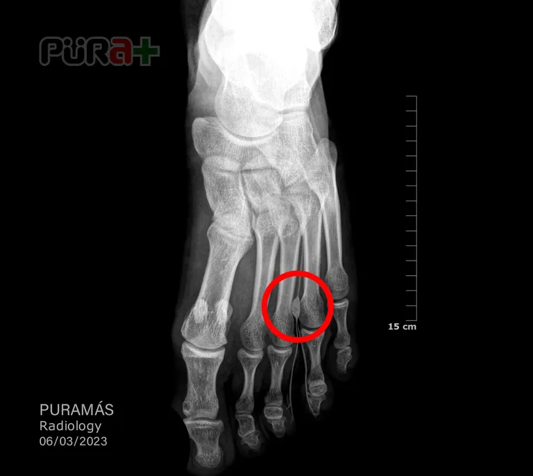 Morton's neuroma ซึ่งอาจเกิดจากภาวะ Morton's toe ได้