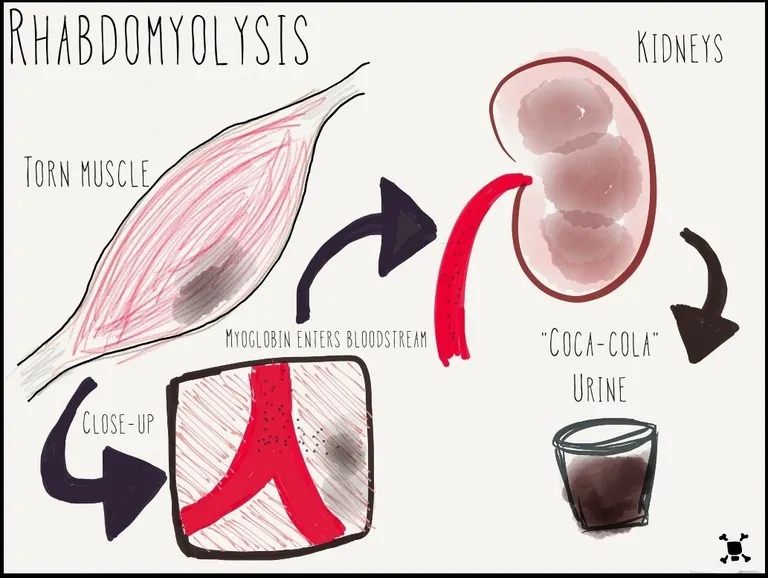 ภาวะ Rhabdomyolysis หรือภาวะกล้ามเนื้อสลายเฉียบพลัน ทำให้เกิดภาวะปัสสาวะสีโค้ก