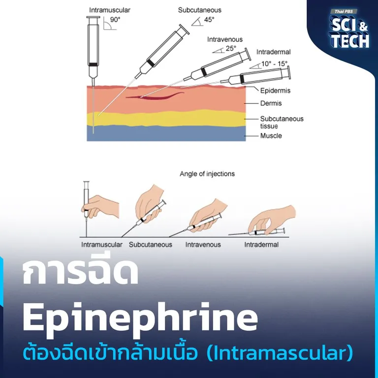 การฉีดยาเข้ากล้ามเนื้อ (Intramascular Injection_ IM) นั้นทำโดยการตั้งเข็มฉีดยาให้ตั้งฉากกับผิวหนังก่อนที่จะกดเข็มลงจนสุด