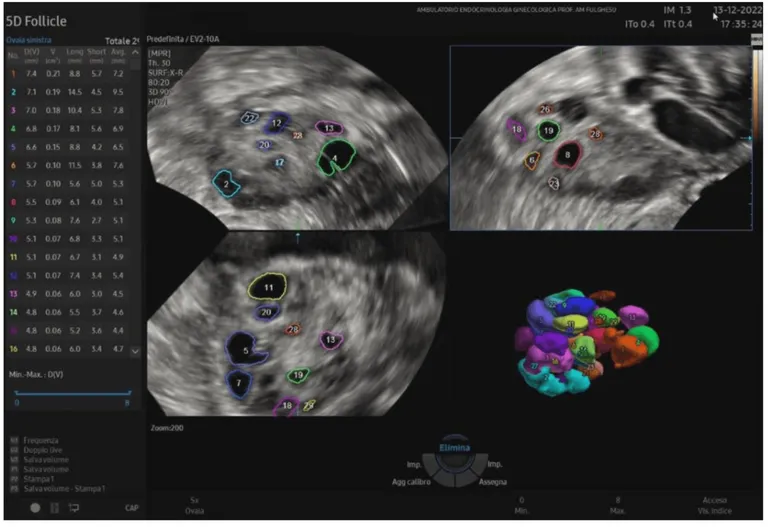 ภาพ Ultrasound แสดงรังไข่ที่มีถุงน้ำหลายใบอยู่ ซึ่งเป็นอาการของภาวะ PCOS