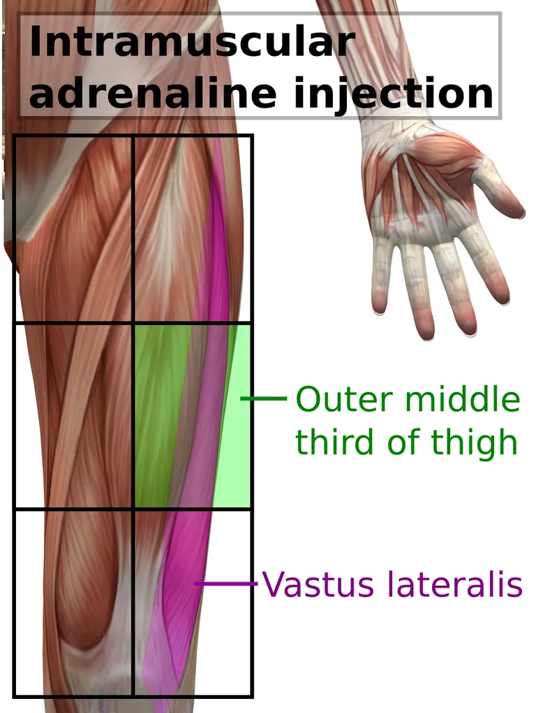 Vastus lateralis คือกล้ามเนื้อบริเวณต้นขา ใช้สำหรับการฉีด Epinephrine