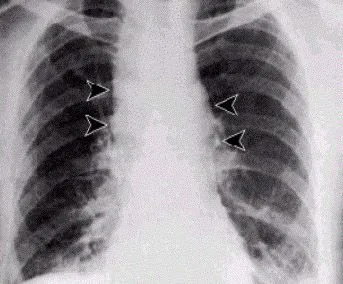 Widened Mediastinum ซึ่งเป็นลักษณะจำเพาะของการติดเชื้อแอนแทรกซ์ในปอด