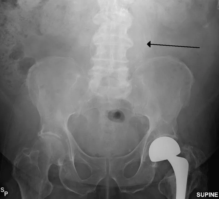 ภาพ X-ray แสดงให้เห็นผนังหลอดเลือดแดงช่องท้องที่โป่งพอง โดยจะเห็นเป็นเส้นจาง ๆ จากการมีแคลเซียมมาเกาะที่ผนังหลอดเลือด
