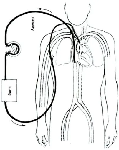 Veno arterial (VA)