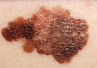 ภาพถ่ายผิวหนังที่มีรอยโรคมะเร็งผิวหนังชนิด Melanoma