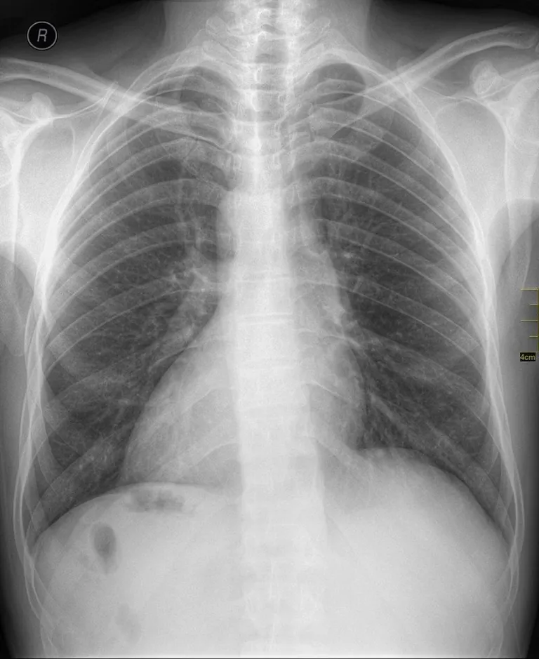 ภาวะ Dextrocardia หรือภาวะหัวใจกลับด้าน เป็นหนึ่งในองค์ประกอบของโรค Situs inversus