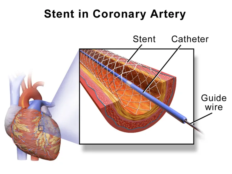 การทำ PCI เพื่อใส่ Stent ในเส้นเลือดหัวใจ