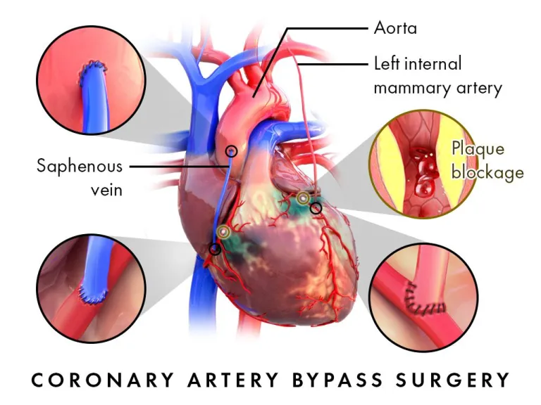 การผ่าตัด CABG เพื่อนำหลอดเลือดจากจุดอื่นมาสร้างทางเบี่ยงหัวใจ