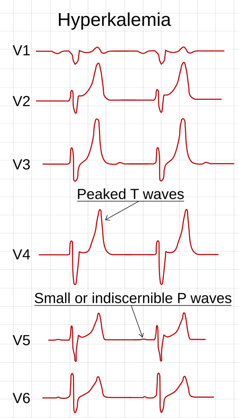 ECG ในผู้ที่มีภาวะโพแทสเซียมสูง Hyperkalemia