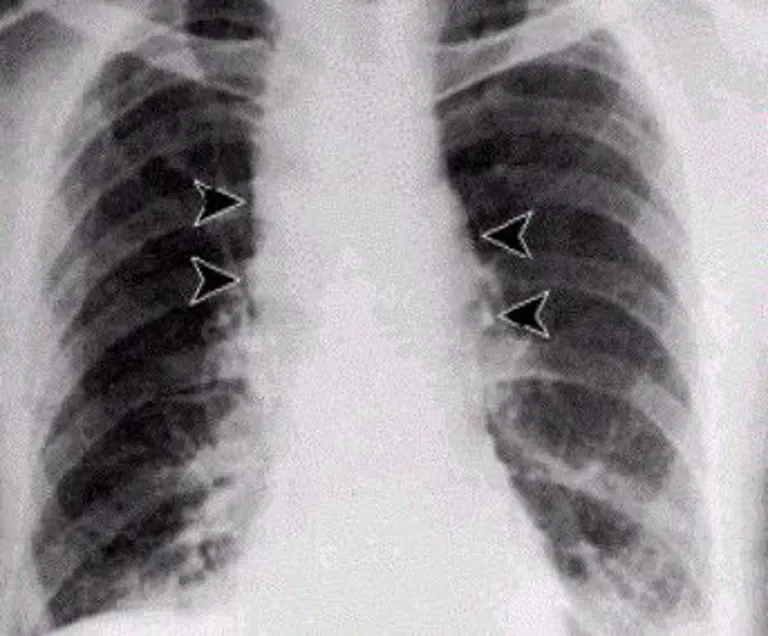 Widened Mediastinum ซึ่งเป็นลักษณะจำเพาะของการติดเชื้อแอนแทรกซ์ในปอด