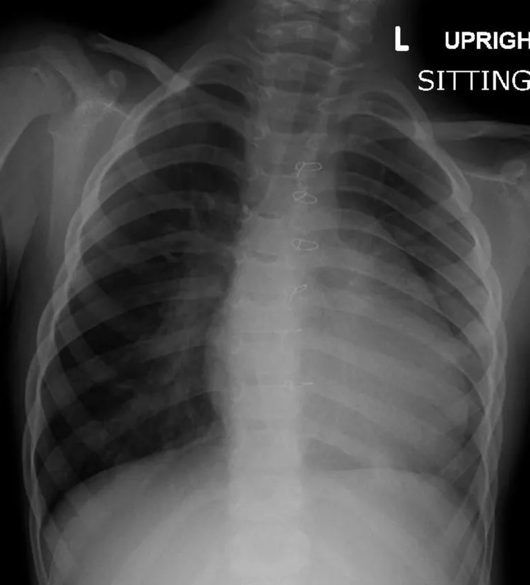 ภาพ X-ray ทรวงอกของเด็กที่เป็น TOF