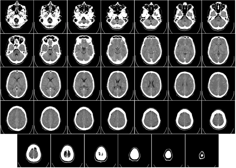ภาพ CT Scan ของสมองจากบริเวณฐานกระโหลกสู่บริเวณหนังศีรษะ