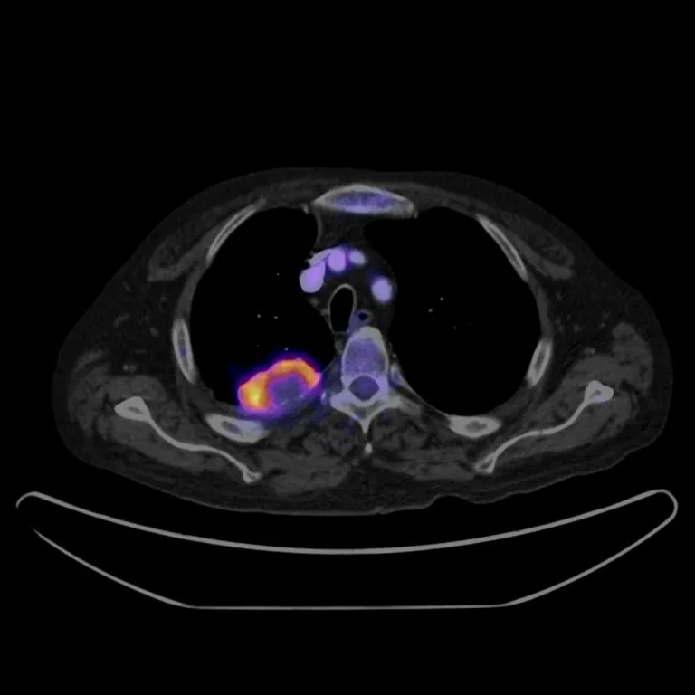 ภาพ PET-CT ทรวงอก แสดงให้เห็นบริเวณที่ร่างกายมีการใช้น้ำตาลหรือมีการ Metabolism สูง ซึ่งอาจบ่งชี้โรคมะเร็ง