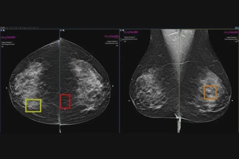 AI enhanced mammogram ภาพจาก สมาคมรังสีวิทยาแห่งอเมริกาเหนือ (RSNA)